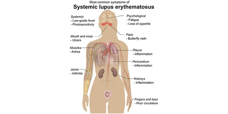 SLE Wikipedia
